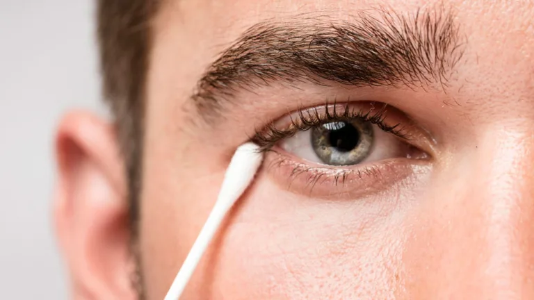 Ceratocone aumenta risco de catarata em jovens